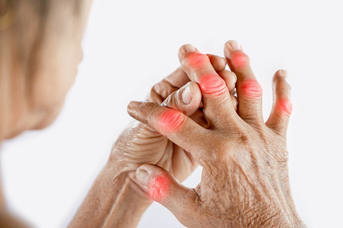 close-up of a woman's hand, suffering from joint pain and swelling in her knuckles and fingers.